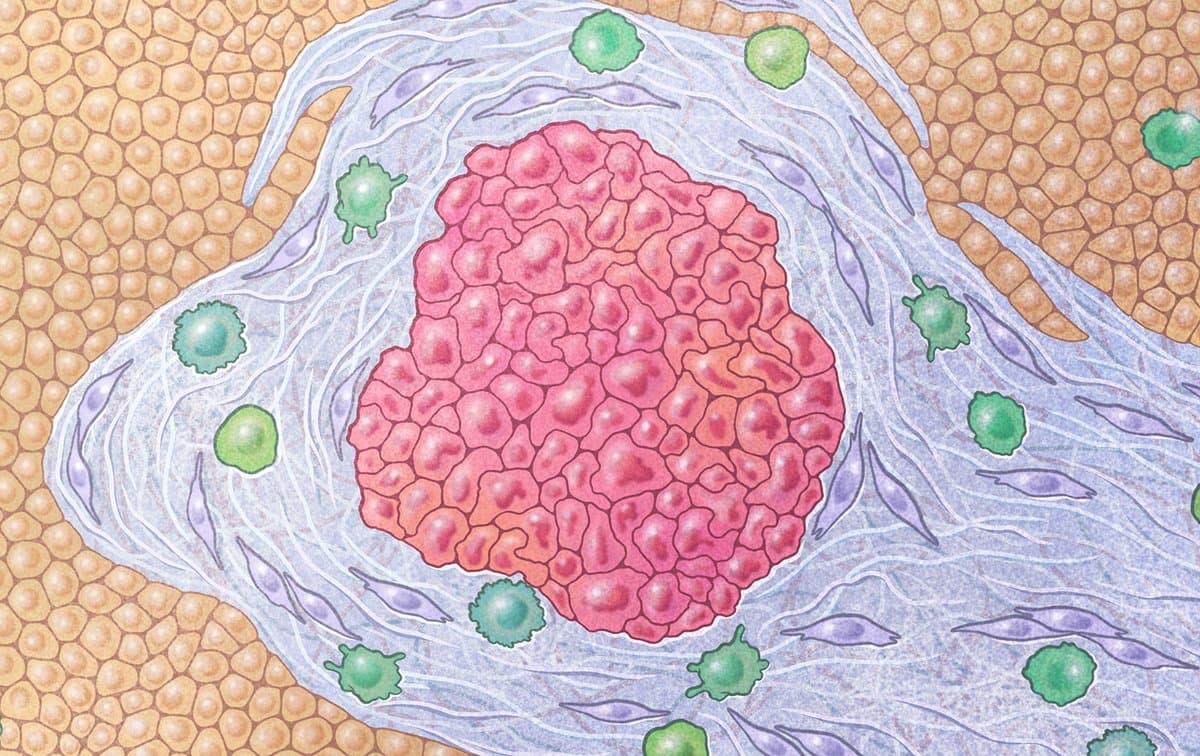 Paricalcitol Shows Promise in Metastatic Pancreatic Cancer
