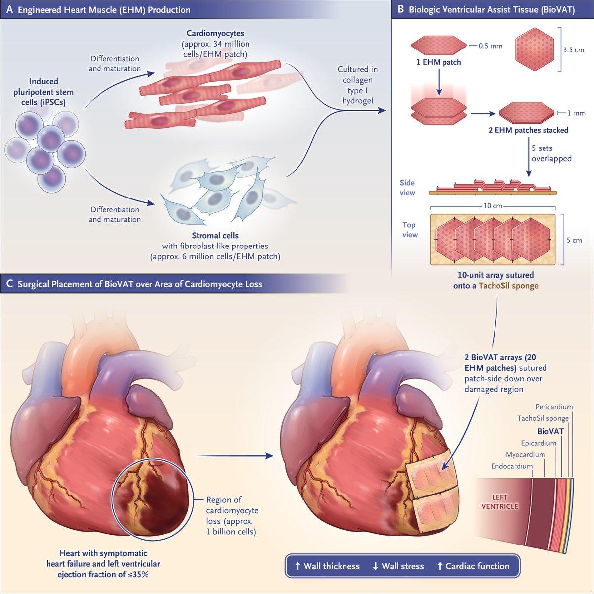 Stem‑cell Heart Patches Improve Outcomes in 12 of 20 Patients