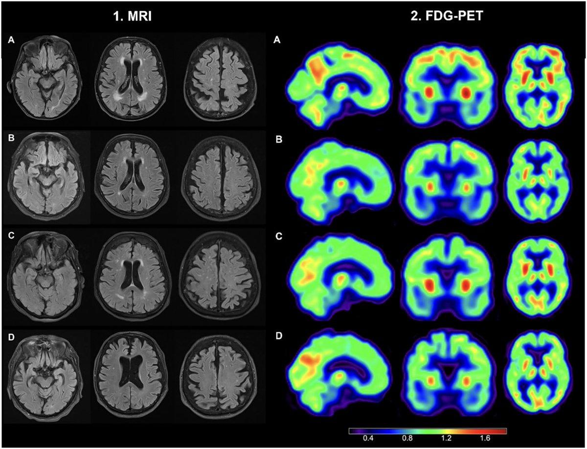 APOE Ε2 Variant Boosts Longevity and Cognitive Resilience