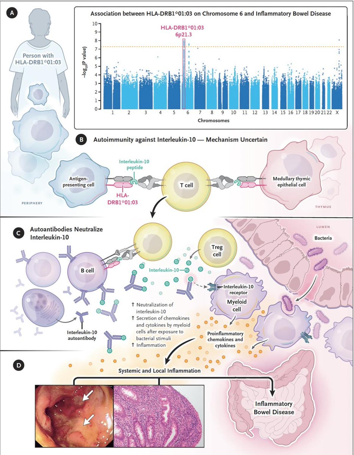 Rare IL‑10 Autoantibody Subset May Respond to CAR‑T