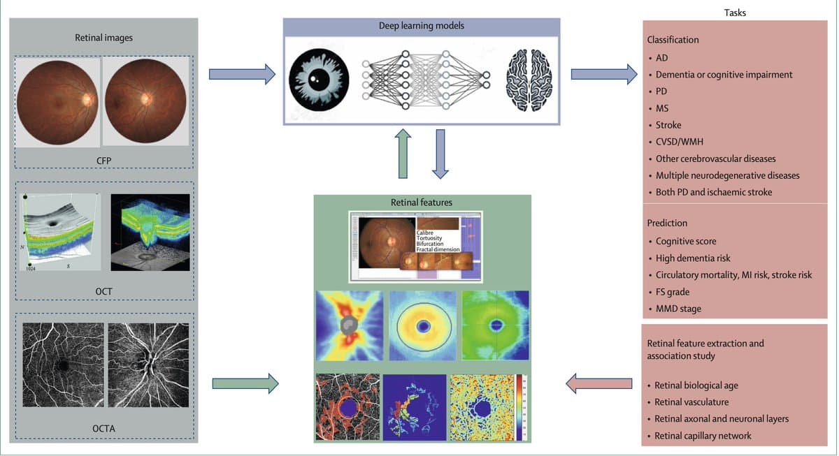 AI Reads Brain Health From Retinal Photos
