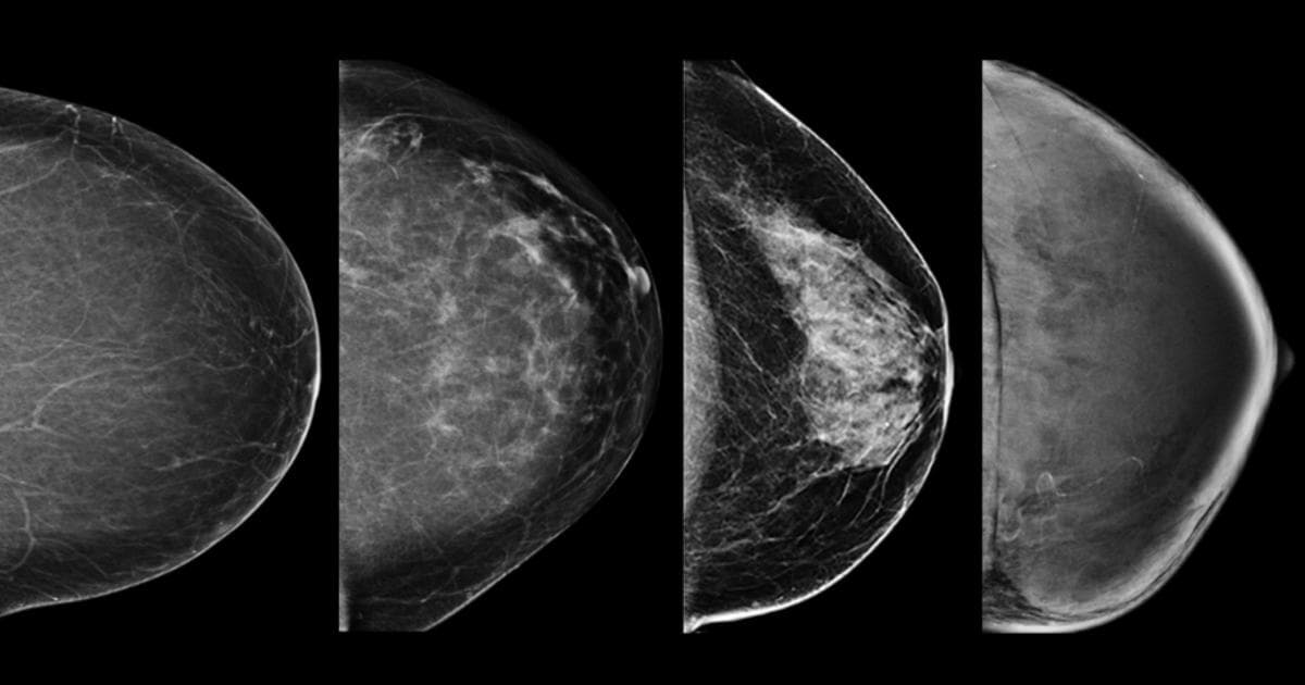 AI Model Helps Discern Patients' Need for Supplemental Breast Imaging