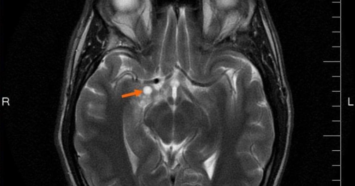 Researchers Land $3.2M Grant to Advance MRI's Role in Diagnosing Glioblastoma