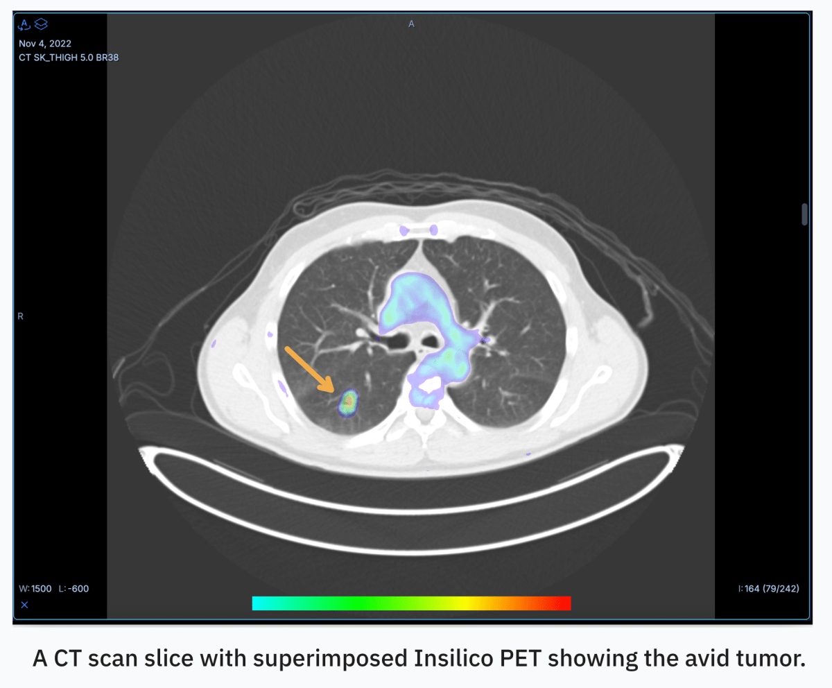 Oxford Spinout RADiCAIT Raises $1.7M Pre-Seed and Opens $5M Seed Raise to Advance AI PET-From-CT Imaging