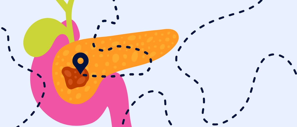 Most Detailed Spatial Atlas yet for Mapping the Pancreatic Tumor Microenvironment