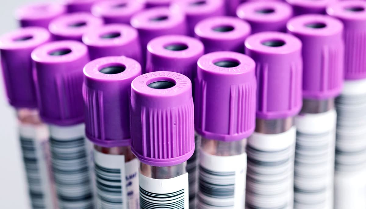 AI-Powered Blood Test Could Transform Dementia Diagnosis