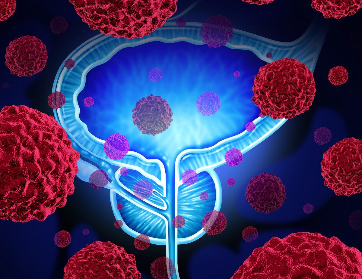 StockWatch: EnGene Shares Crater on Declines in Complete Response Rates to Bladder Cancer Therapy