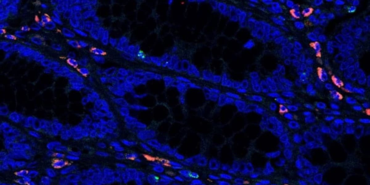 New Test Could Help Pinpoint IBD Diagnosis, Study Finds