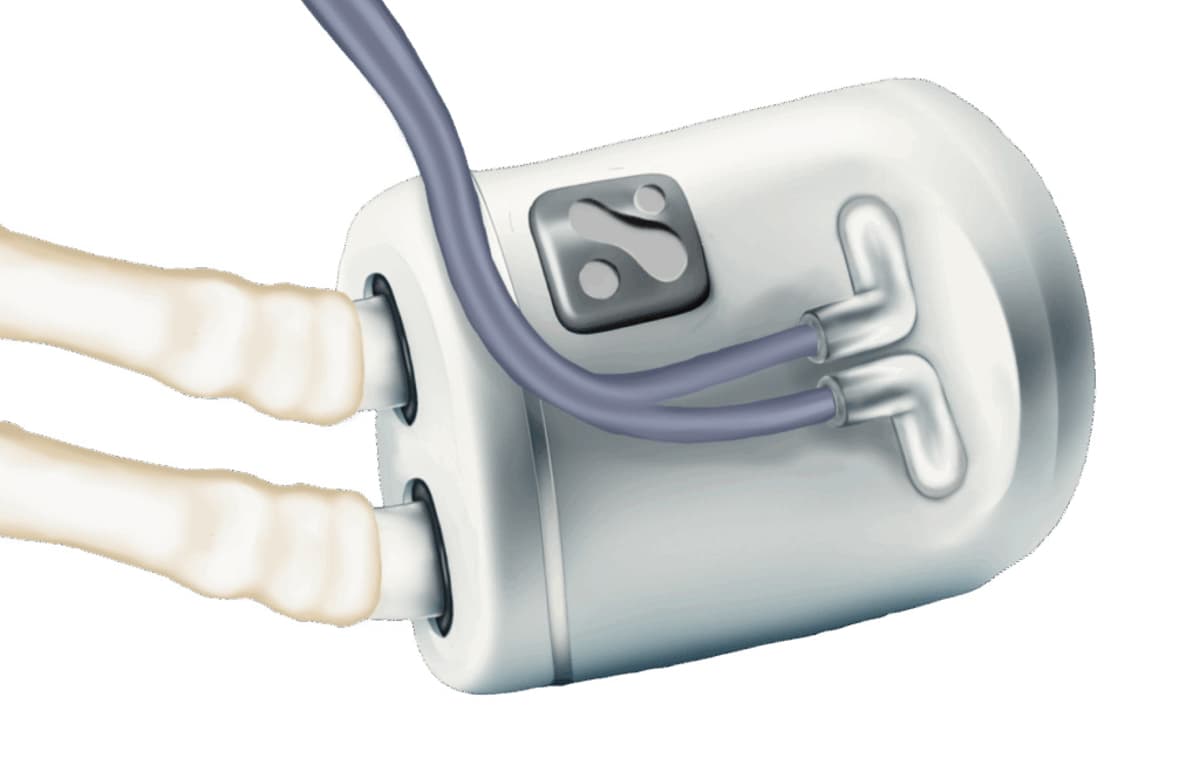 FDA Picks Nephrodite’s Implantable Dialysis System for TAP Pilot