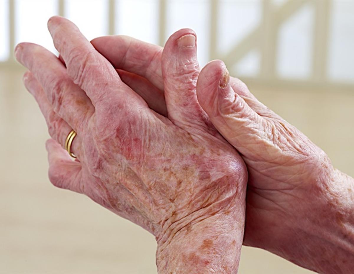 Pim1 Identified as Promising Therapeutic Target for Inflammatory Arthritis Treatment