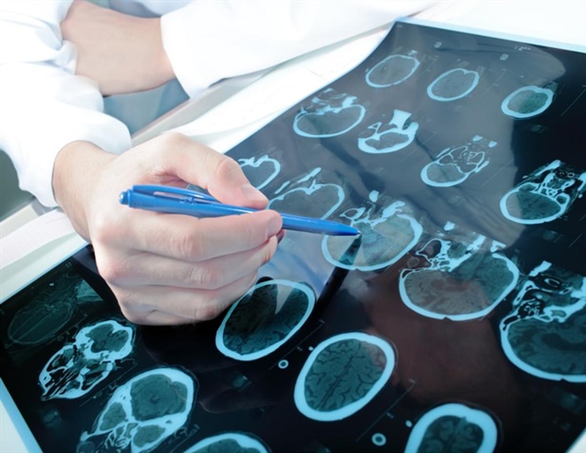 Deep Learning Model Predicts Vascular Cognitive Impairment From Brain Scans
