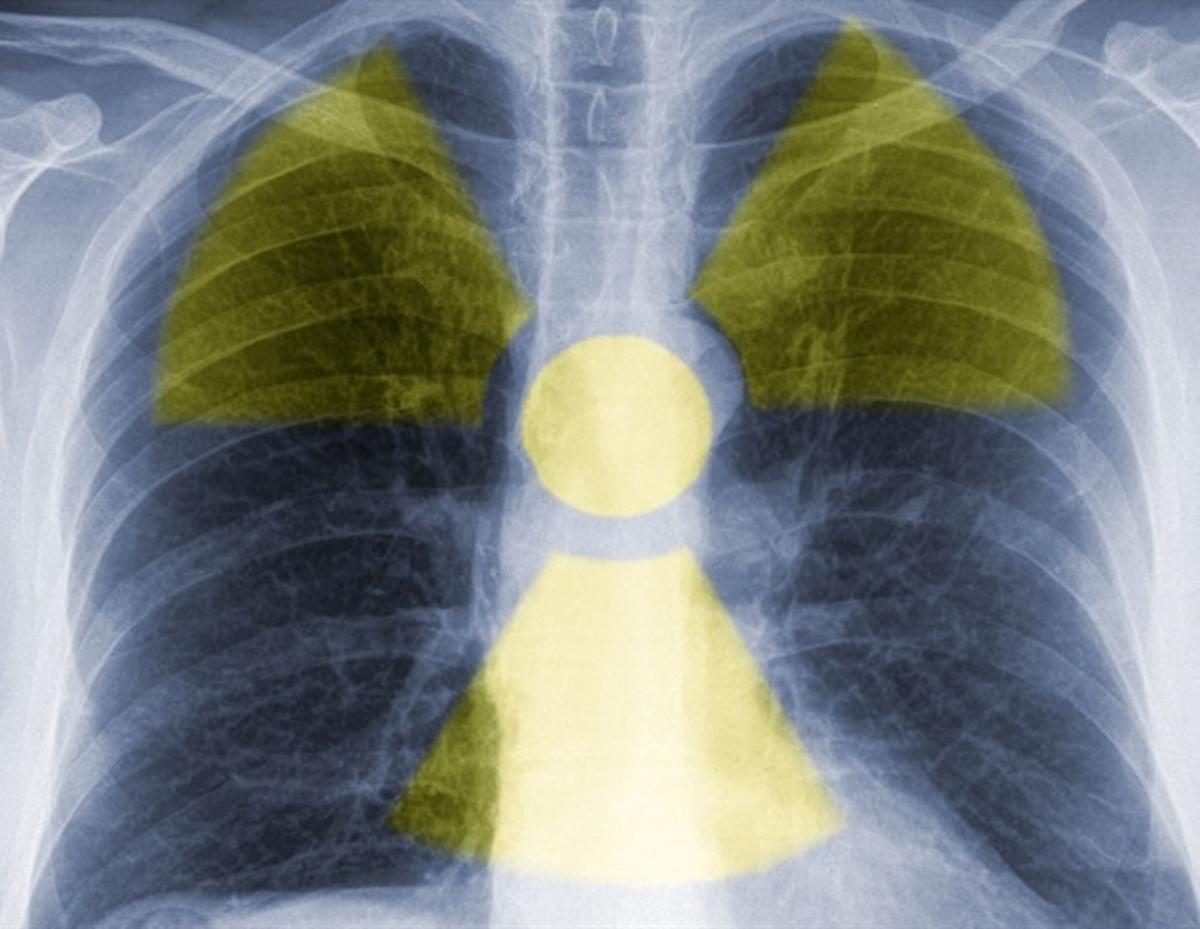 New Imaging Method Distinguishes Inflammation From Lung Fibrosis