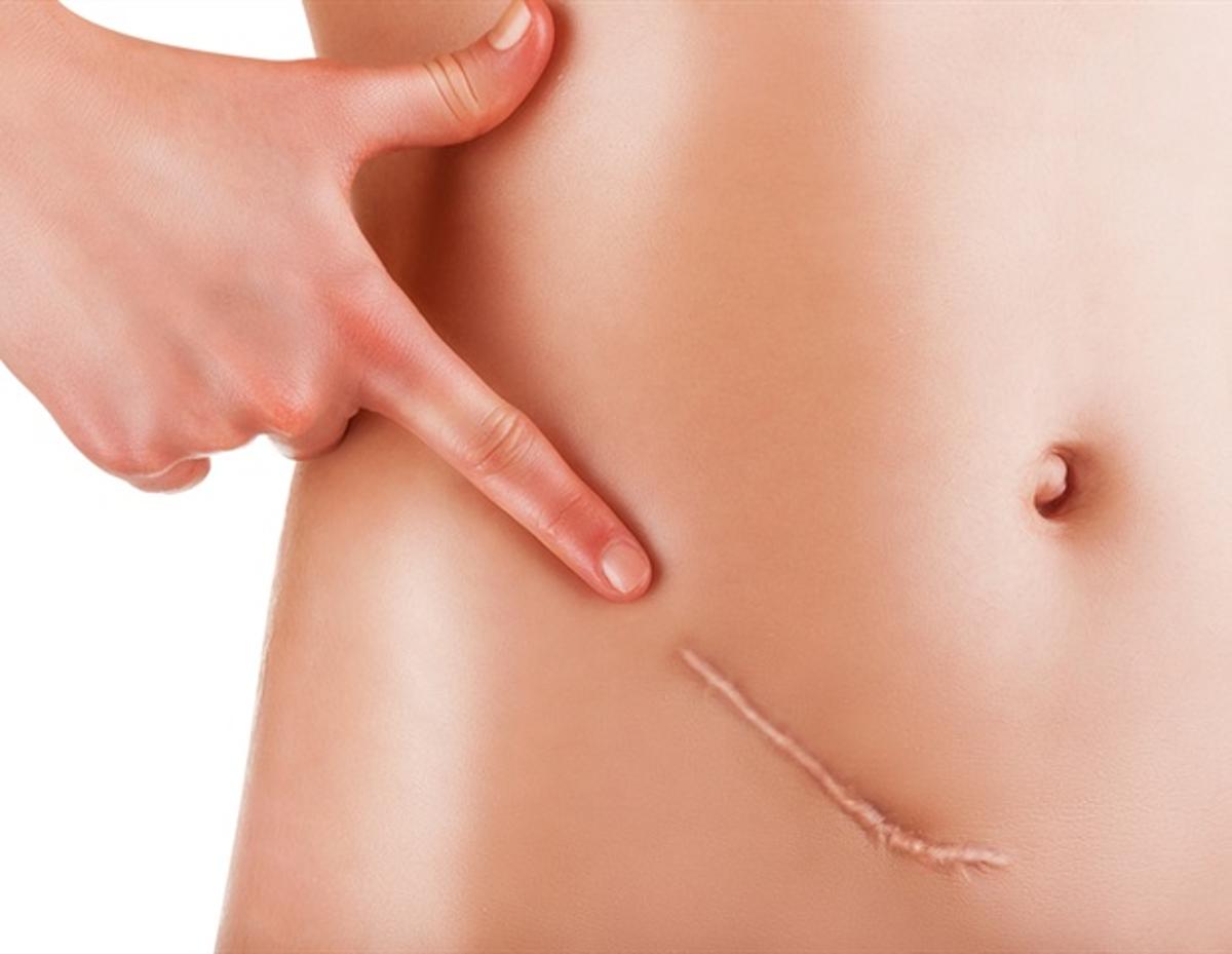 Implantable Cytokine Factories Show Promise Against Advanced Ovarian Cancer