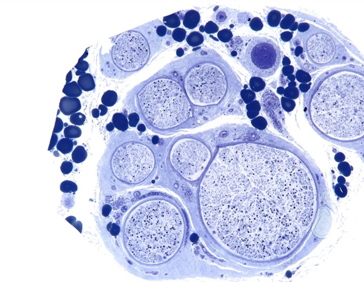 Cryoprobe Improves Diagnostic Accuracy in Transbronchial Lung Biopsies