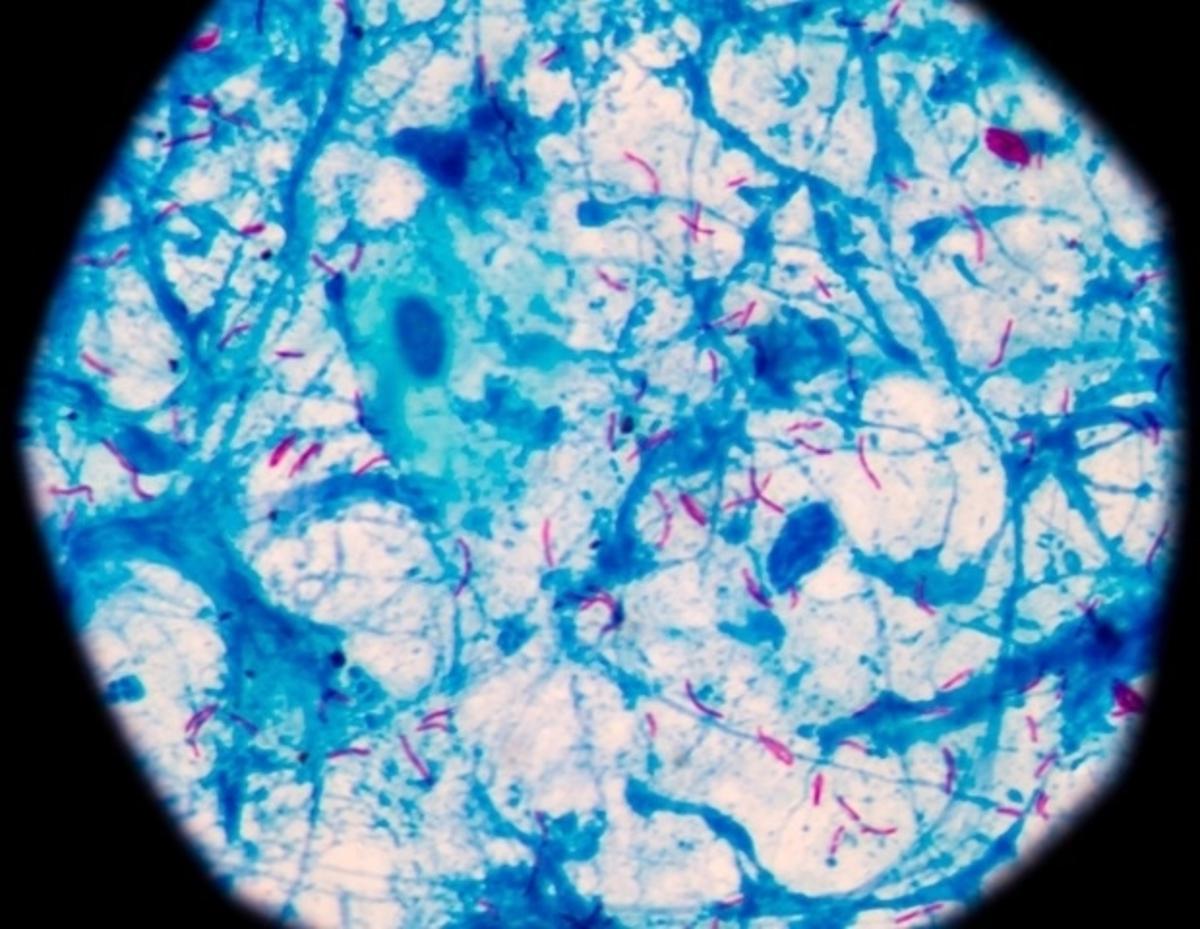 Blood Test May Improve Early Tuberculosis Detection Among Household Contacts