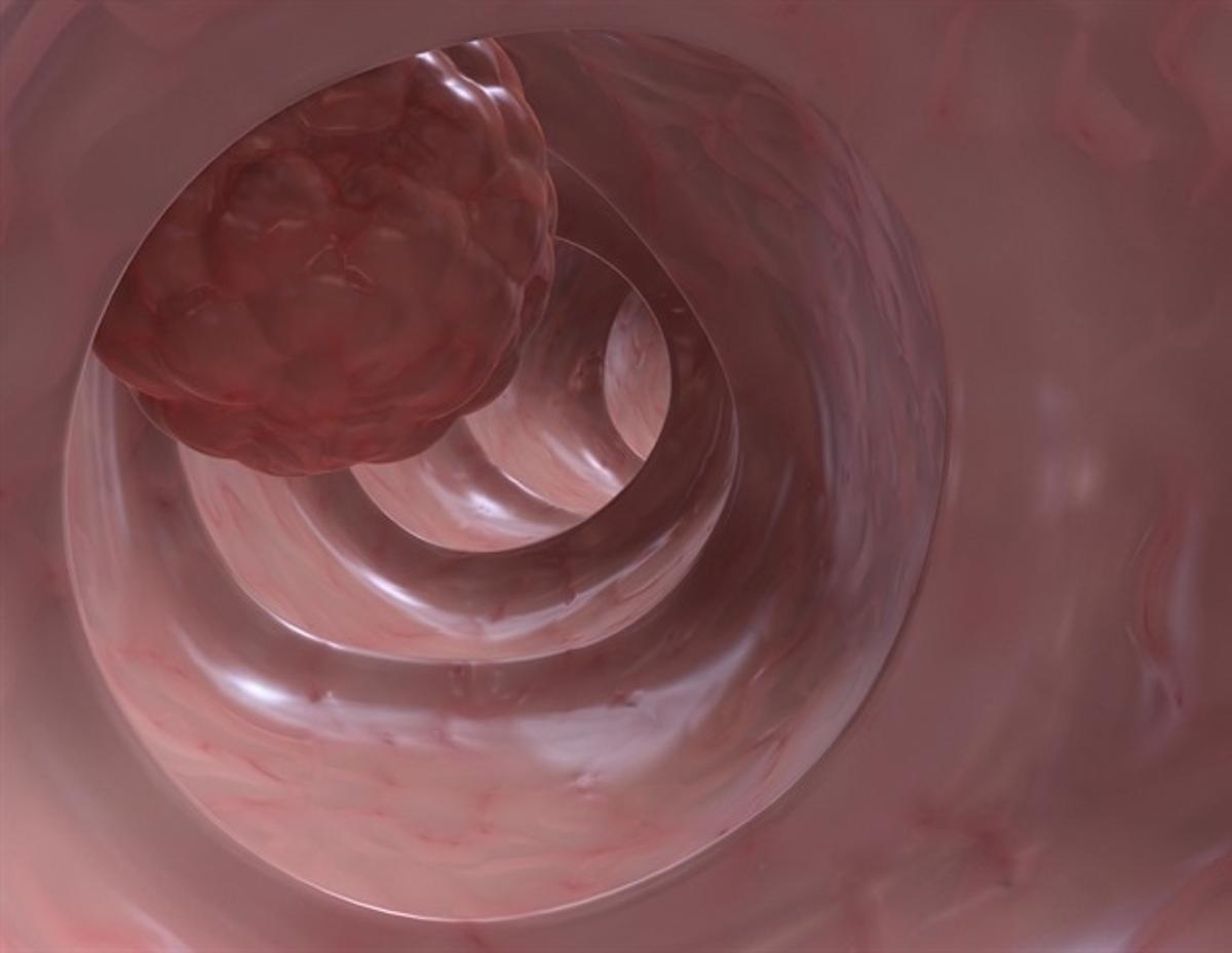 Targeting Tumor-Specific Inflammatory Process May Prevent Drug Resistance in Colon Cancer