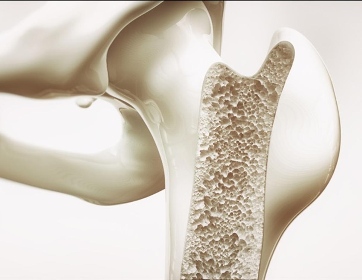 Clinical Trial Challenges Long Held Beliefs About Treating Brittle Bone Disease