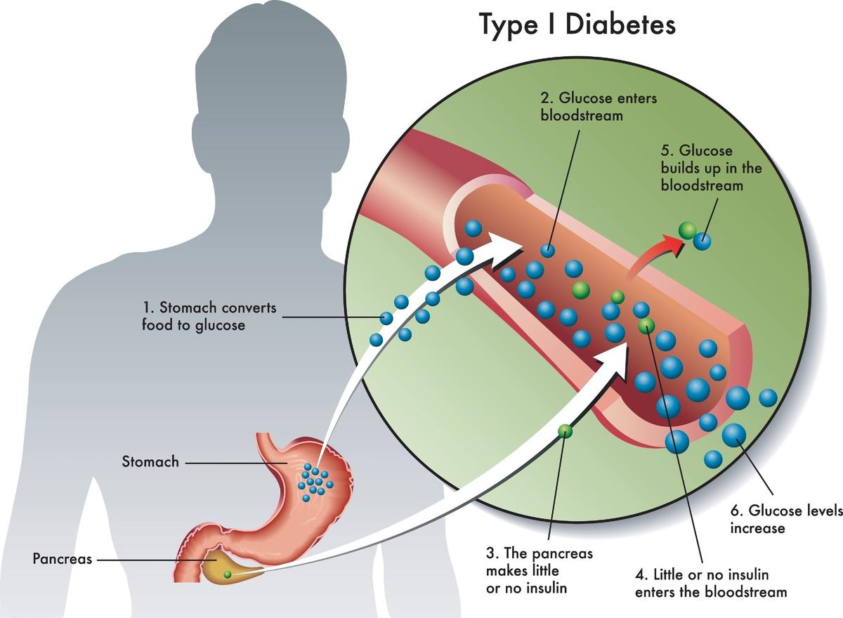 New Therapies Could Help Type 1 Diabetes Care Move Beyond Insulin Alone