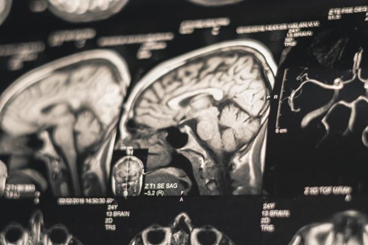 NIH-Funded Study Clearly Ties Risk of Dementia to Severe CTE