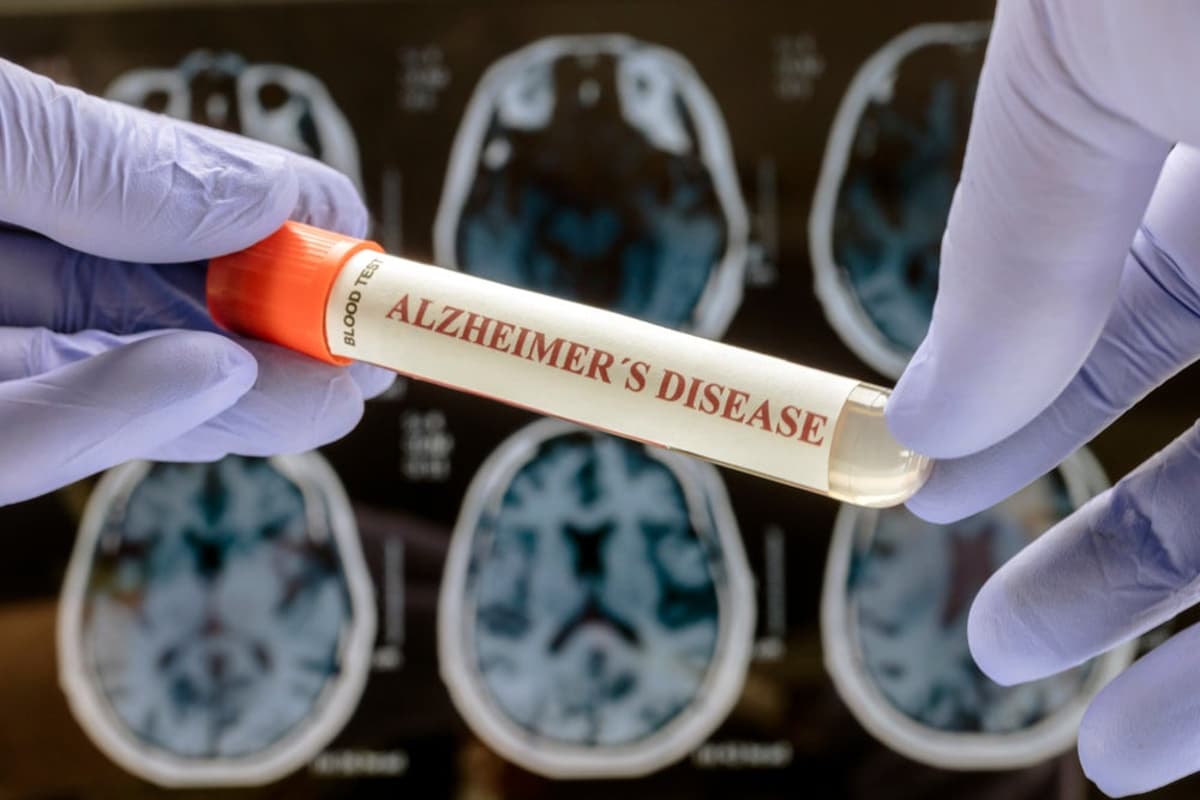 Developers Back Alzheimer’s Drugs Despite Report Suggesting Lack of Efficacy