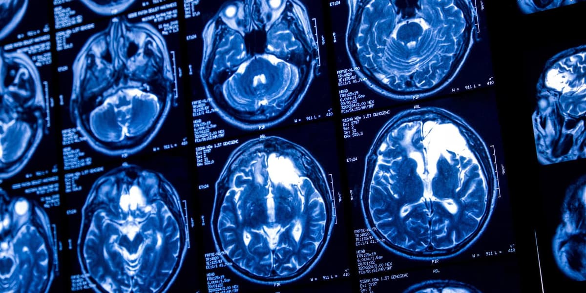 Even Light Drinking Combined with Aging Is Linked to Reduced Brain Blood Flow and Thinner Tissue