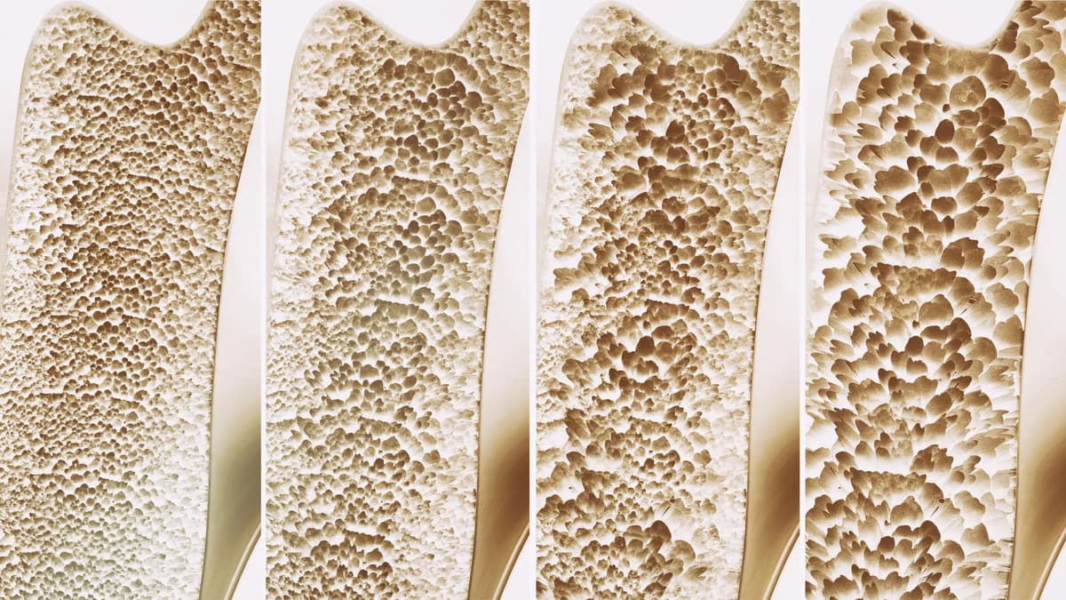Millions Take Calcium and Vitamin D for Stronger Bones. A Major Review Finds Little Benefit
