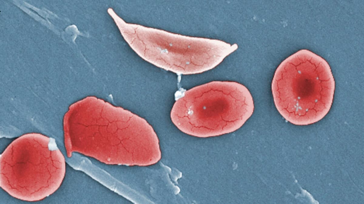 STAT+: Vertex’s CRISPR Treatment for Sickle Cell Disease Hits Unexpected Roadblock