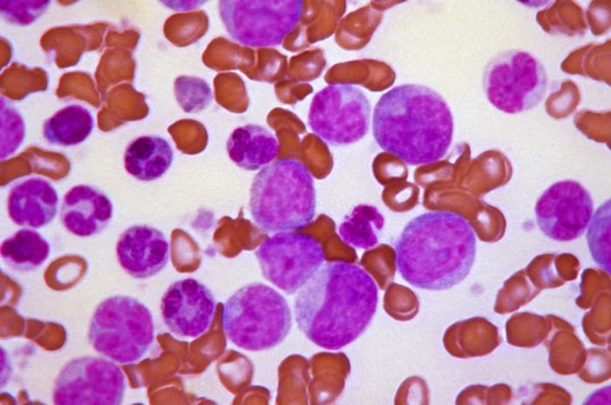 STAT+: Enliven Therapeutics’ Leukemia Drug Shows Promise in New Study
