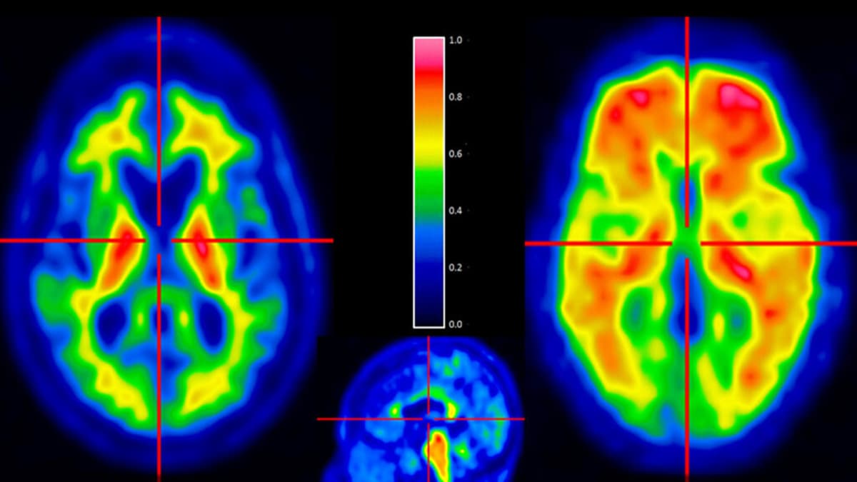 STAT+: Axsome Wins FDA Nod for Alzheimer’s Agitation
