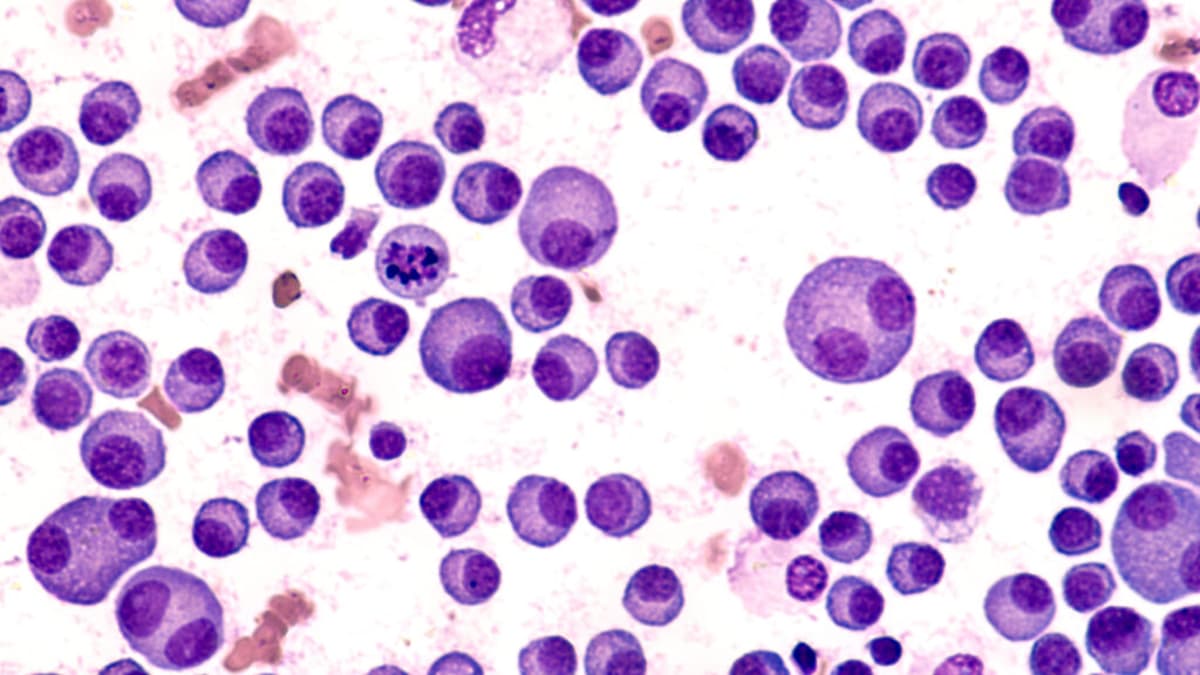 STAT+: In Early Trial, CAR-T Results Raise Hope of Preventing Multiple Myeloma in High-Risk Patients
