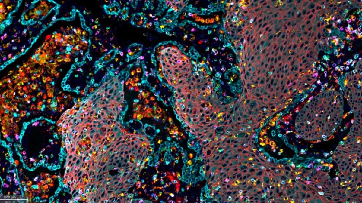 STAT+: Finally Cracking KRAS as a Druggable Target