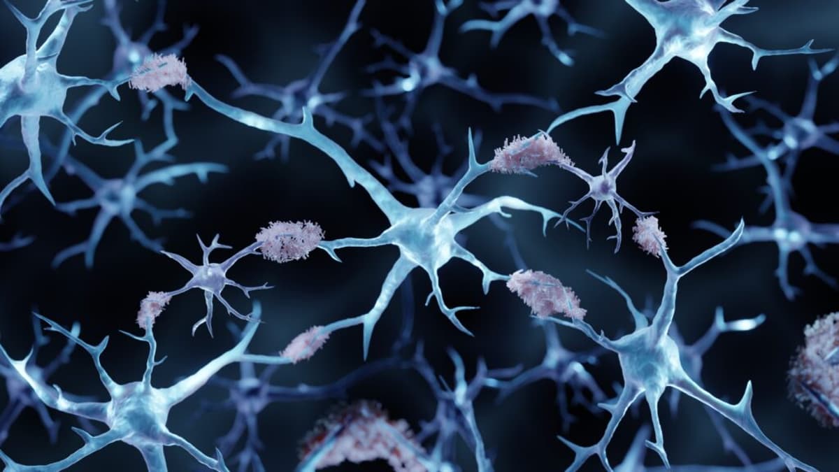 STAT+: Cochrane Review Reignites Alzheimer’s Amyloid Wars