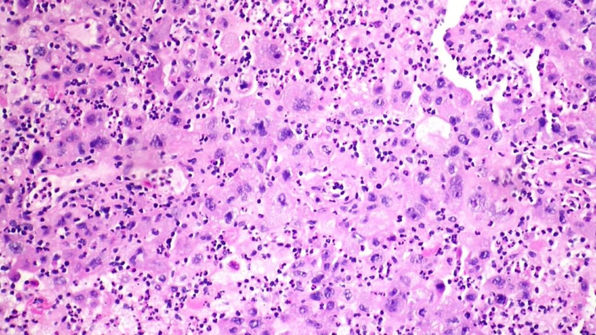 STAT+: Merck-Kelun Lung Cancer Drug Cut Risk of Tumor Progression by 65%, ASCO Abstract Shows