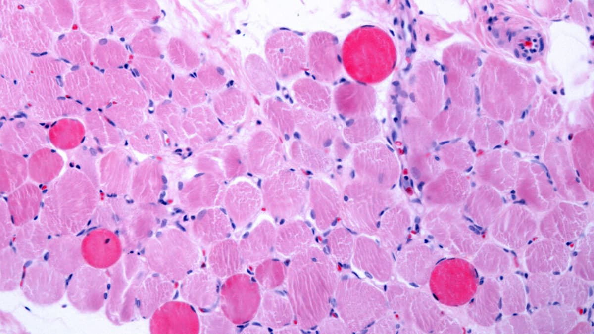 STAT+: Capricor Therapeutics Accuses Nippon Shinyaku of Slow-Walking Plans on Duchenne Drug