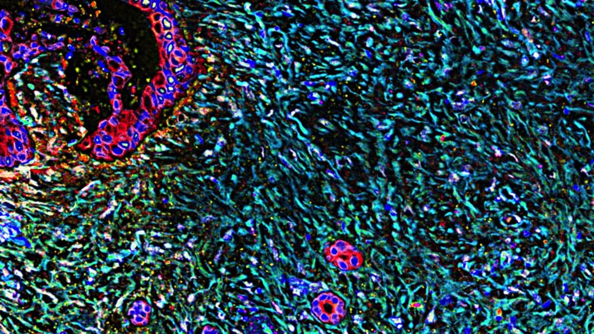 STAT+: Erasca Touts Strong, Though Preliminary, Results in Trial of Pancreatic and Lung Cancer Therapy