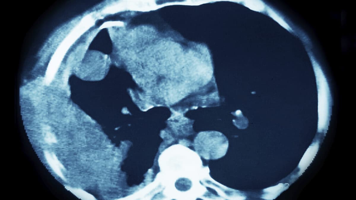 STAT+: Akeso and Summit’s Ivonescimab Extends Survival in Squamous Cell Lung Cancer