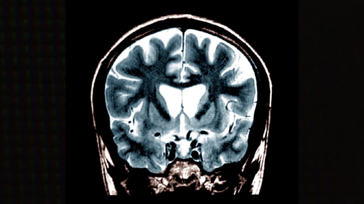Latus Bio Raises $42M to Launch Huntington’s Disease Trial