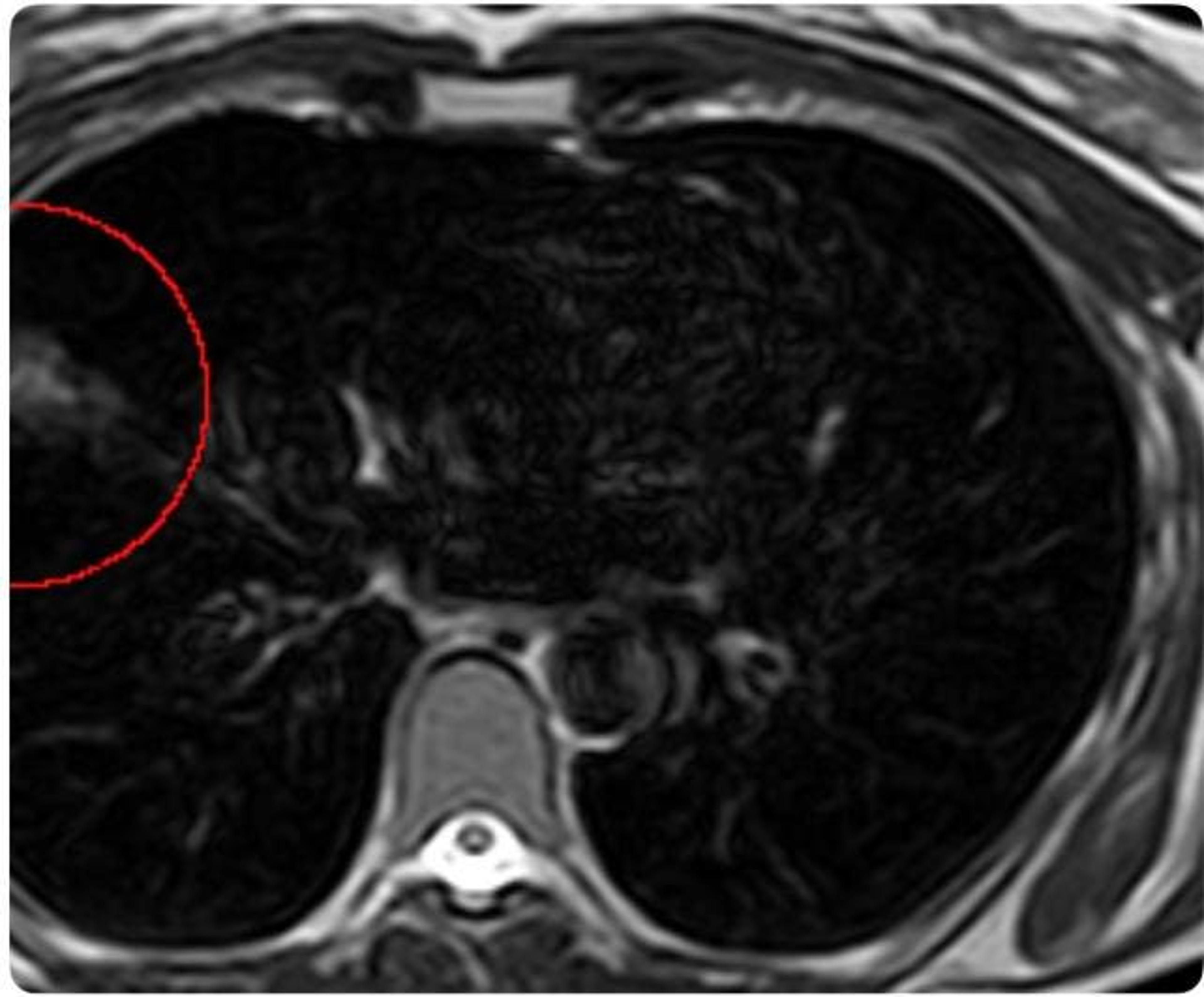 Lung Cancer Rising Among Never-Smokers. Screening For This Group Lags.