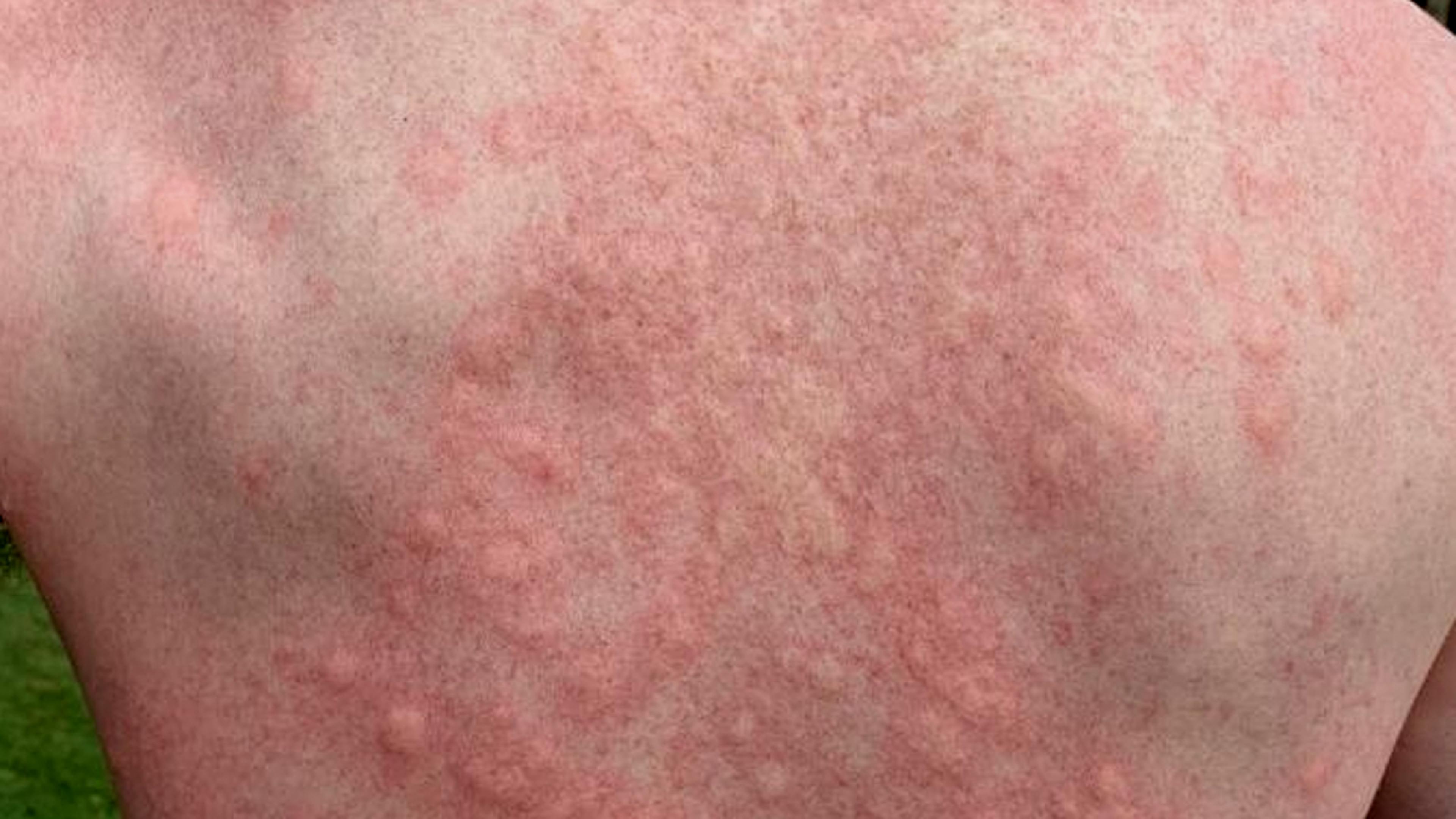 Novartis' Oral BTK Drug Moves the Needle in CINDU